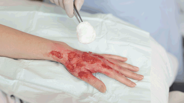 A photo of a hand with burn injuries.