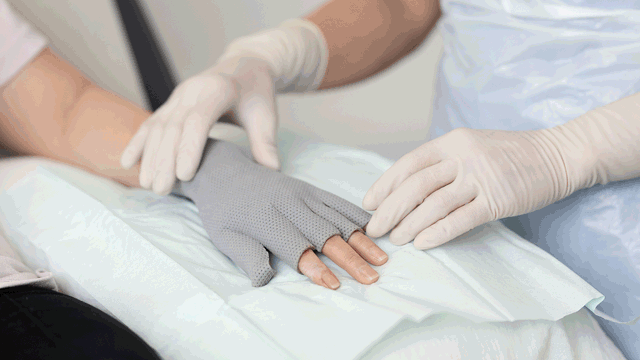 A photo of a hand with a burn dressing.