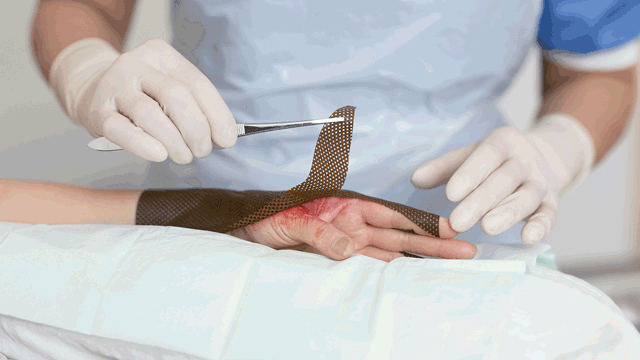 A photo of a burn dressing being applied to a hand with a burn injury.