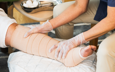 VLU - venous leg ulcers