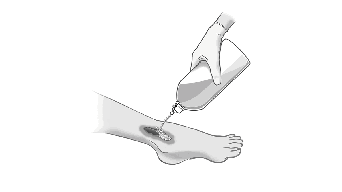 An illustration showing a bottle spraying wound cleanser on a wound.