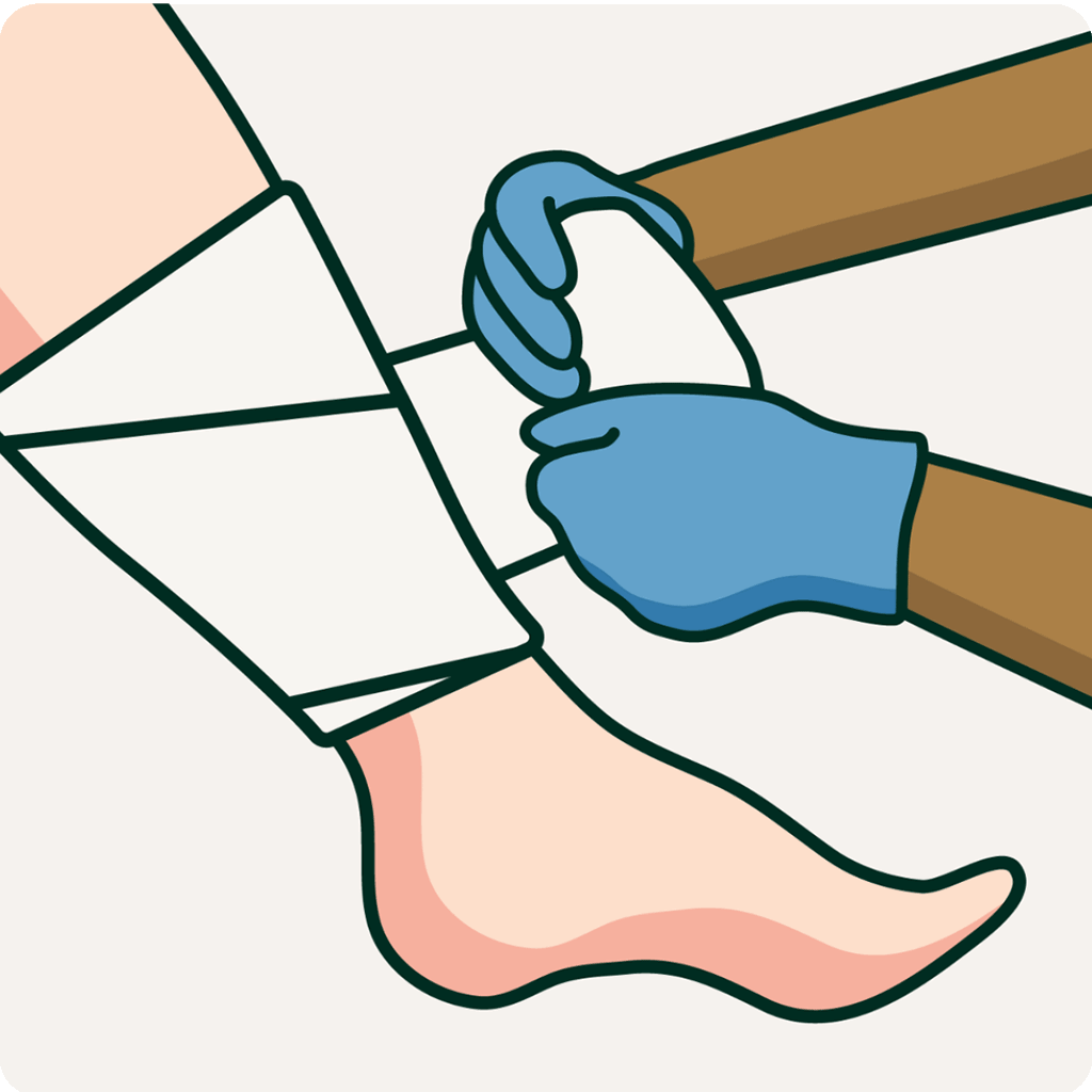 A pair of hand applying a dressing to a leg ulcer. Illustration.