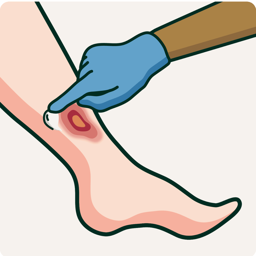 A hand applying moisturizer to a leg ulcer. Illustration.